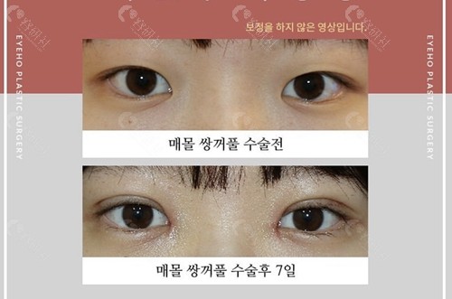韩国爱护整形医院双眼皮整形对比图