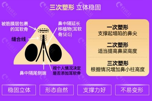 杭州维多利亚唐红伟医生埃菲尔黄金软骨鼻技术优势分析