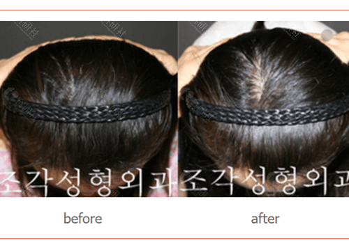 韩国雕刻整形外科宋龙泰骨水泥填充后脑勺对比图