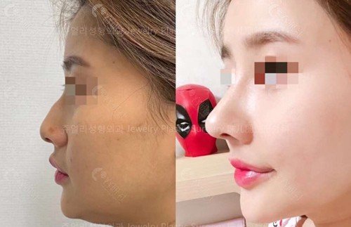 韩国珠儿丽整形外科鼻整形对比图