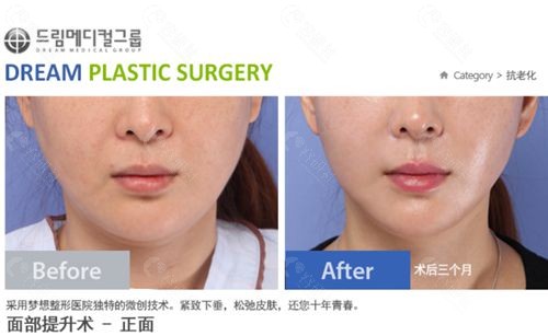 韩国梦想整形外科中下面部拉皮手术对比照