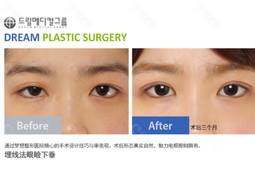 韩国梦想整形外科医院双眼皮手术对比图