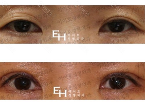 韩国爱护整形医院双眼皮对比图