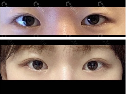 韩国TS整形外科医院眼综合手术对比图