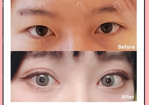 韩国珠儿丽整形外科眼综合手术对比图