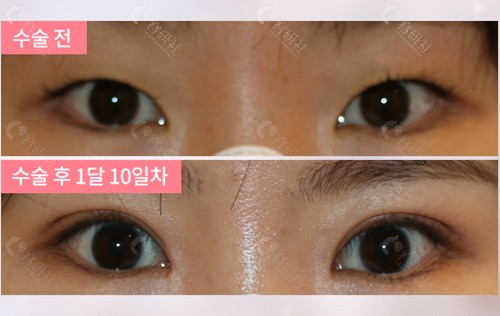 韩国爱护双眼皮+开眼角前后对比照