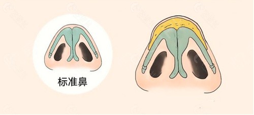 上海徐永丰做的鼻子多少钱？