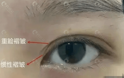 双眼皮术后眼头、眼尾分叉是怎么回事？