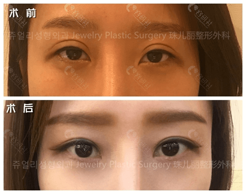 韩国珠儿丽整形外科双眼皮修复怎么样