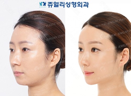 韩国珠儿丽整形外科白寅秀割双眼皮