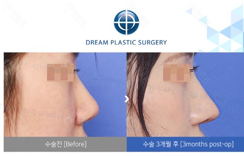 韩国梦想整形外科医院鼻部整形对比图