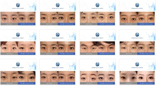 韩国梦想整形外科医院双眼皮手术对比照
