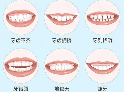 北京牙齿矫正价格是多少