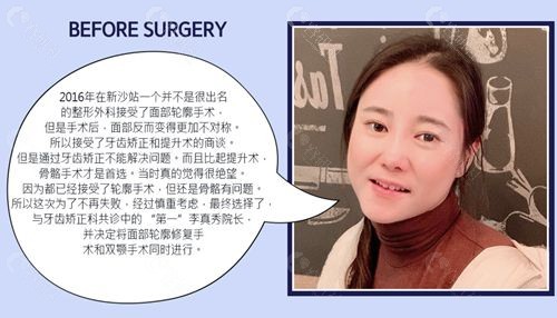 韩国菲斯莱茵整形外科面部轮廓+双鄂手术修复手术前真实讲述