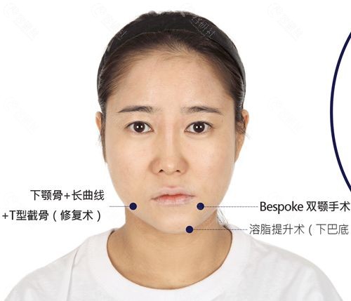 韩国菲斯莱茵整形外科面部轮廓修复手术方案