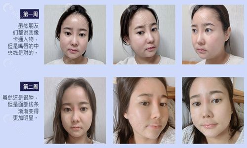 韩国菲斯莱茵整形外科面部轮廓修复手术1-2周变化