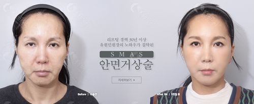 韩国迪美整形外科医院SMAS拉皮手术实例