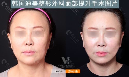 韩国迪美整形外科面部提升手术实例