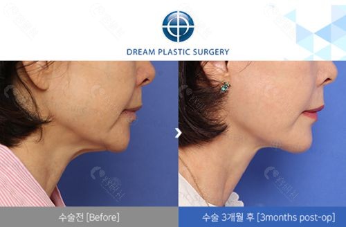 韩国梦想整形外科医院颈部拉皮手术对比照