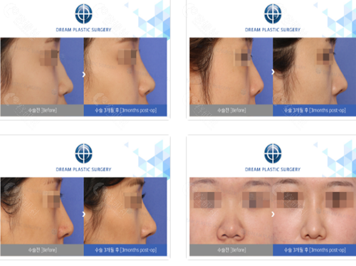 韩国梦想整形外科医院假体隆鼻手术对比图