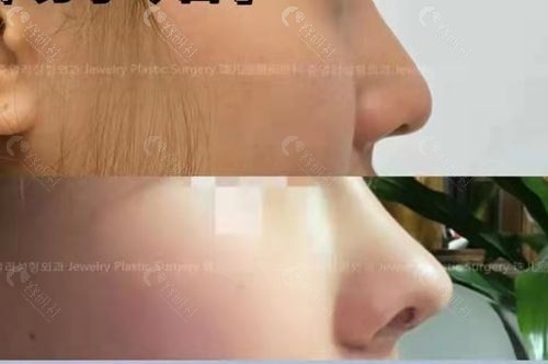 韩国珠儿丽整形外科隆鼻怎么样
