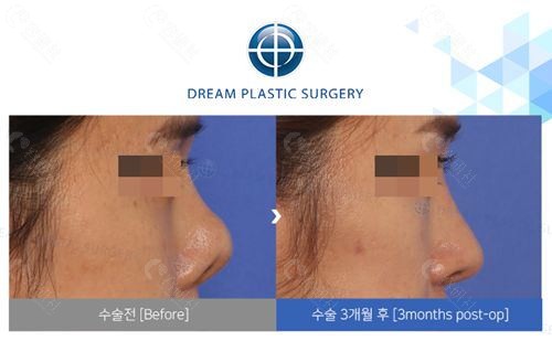韩国梦想整形外科医院隆鼻手术靠谱吗