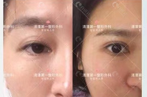 韩国清潭first整形外科医院双眼皮修复对比图