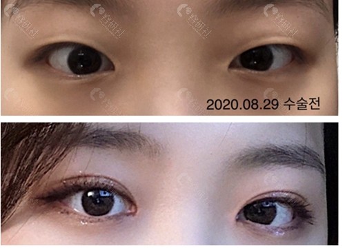 韩国伊美芝整形外科眼综合图片对比照