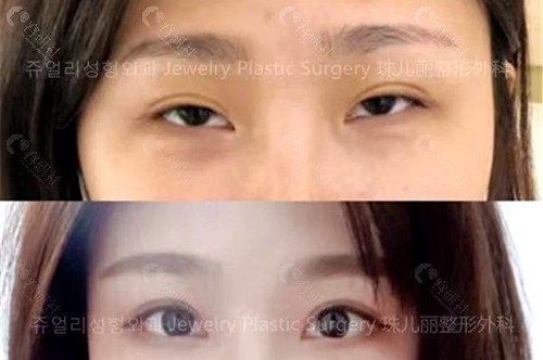 韩国珠儿丽整形外科双眼皮修复手术对比图片