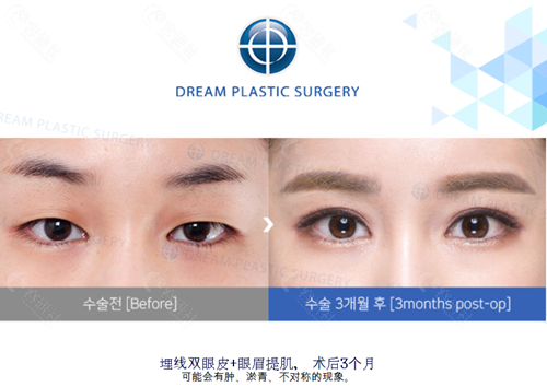 韩国梦想整形外科医院埋线双眼皮对比图片