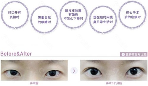 韩国BK整形外科医院埋线双眼皮对比图片
