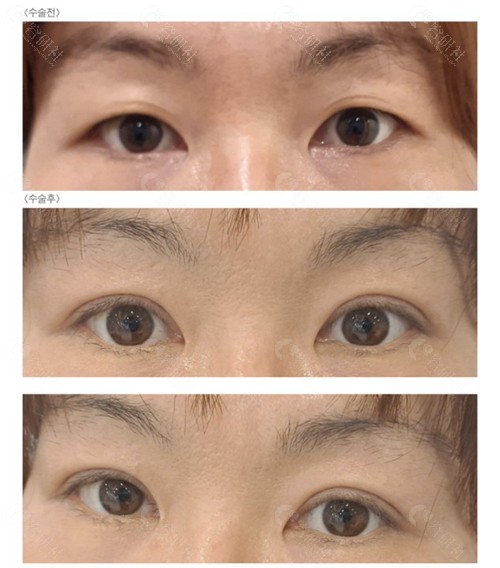 韩国爱护整形外科医院双眼皮手术对比图
