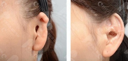 韩国普罗菲耳整形外科耳朵整形照片