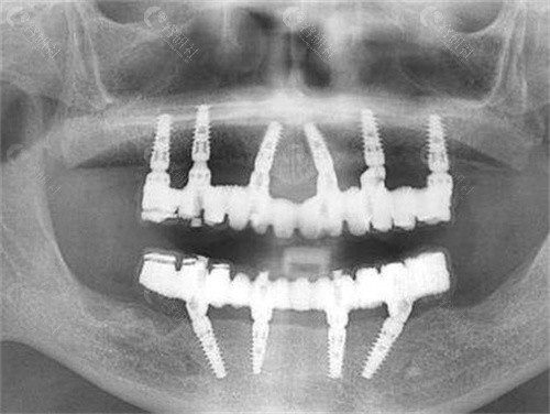 种植牙全口照片