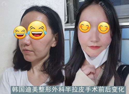 韩国迪美整形外科医院半拉皮手术后照片