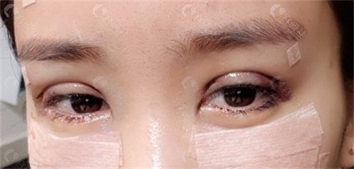 韩国珠儿丽单眼皮变双眼皮过程