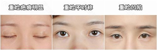 双眼皮失败情况