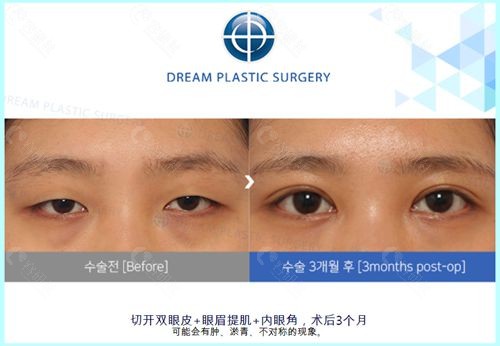 韩国梦想医院开眼角+眼眉提肌+切开双眼皮前后对比照