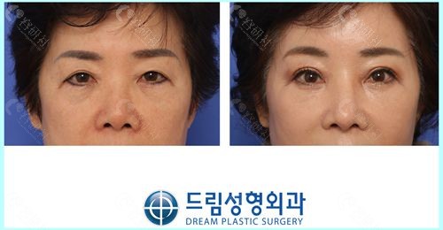 韩国梦想整形医院埋线双眼皮+眼角内疵+提肌矫正手术前后对比图