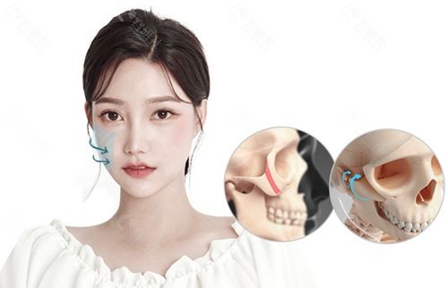 韩国1%整形外科颧骨缩小手术做得怎么样？