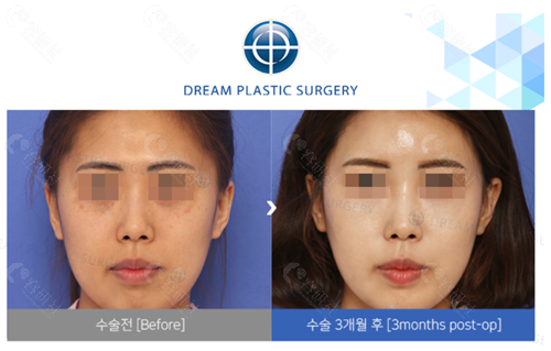 韩国梦想整形外科医院面部脂肪填充对比图