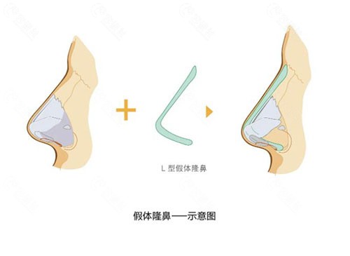 哈尔滨整形医院假体隆鼻价格