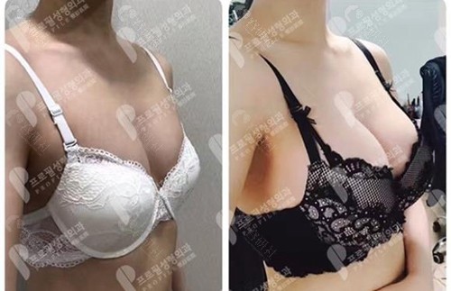 韩国普罗菲耳整形医院假体隆胸对比图