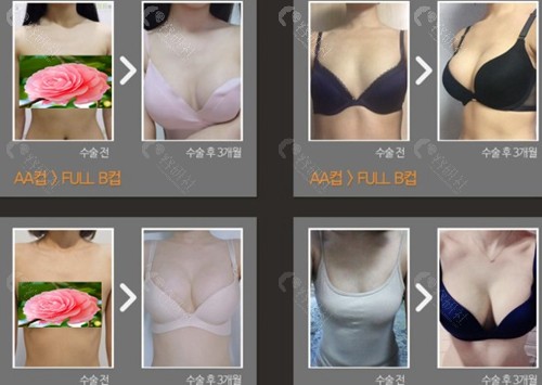 韩国波轮美整形外科假体隆胸对比图