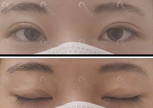韩国爱护双眼皮修复前后对比图