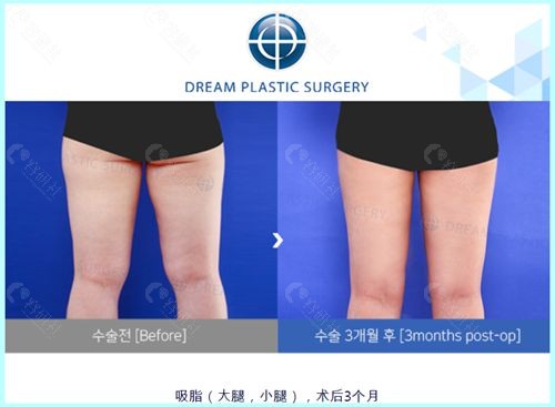 韩国梦想医院吸脂瘦大小腿术前和术后3个月对比照