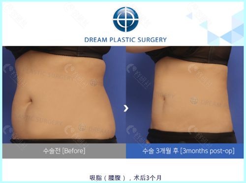 韩国梦想医院吸脂瘦腰腹术前和术后3个月对比照