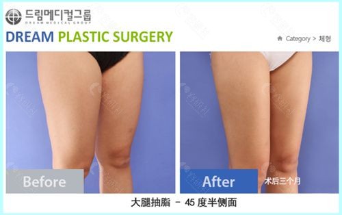 韩国梦想医院大腿吸脂前后对比图