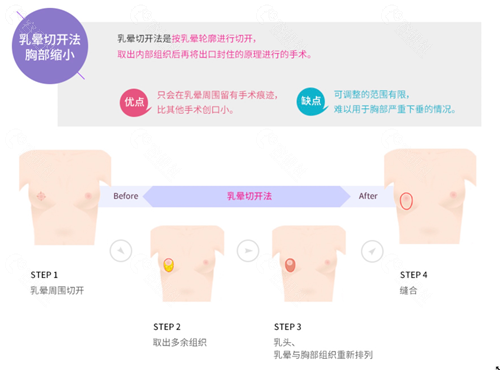 迪美整形外科缩胸技术