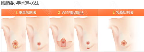 韩国必当归医院缩胸方法